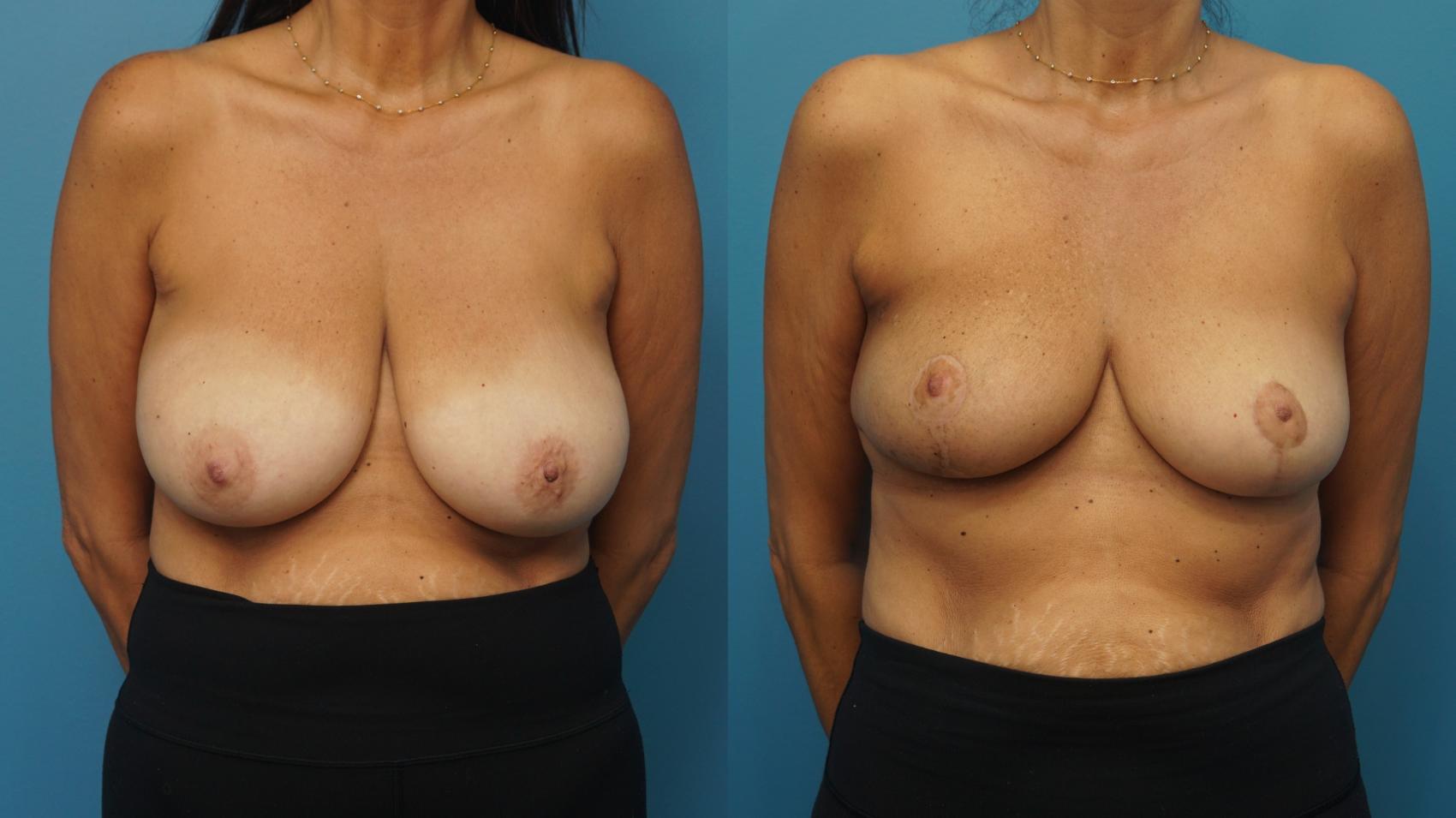 Before & After Oncoplastic Breast Reconstruction after Lumpectomy Case 435 Front View in North Shore, IL