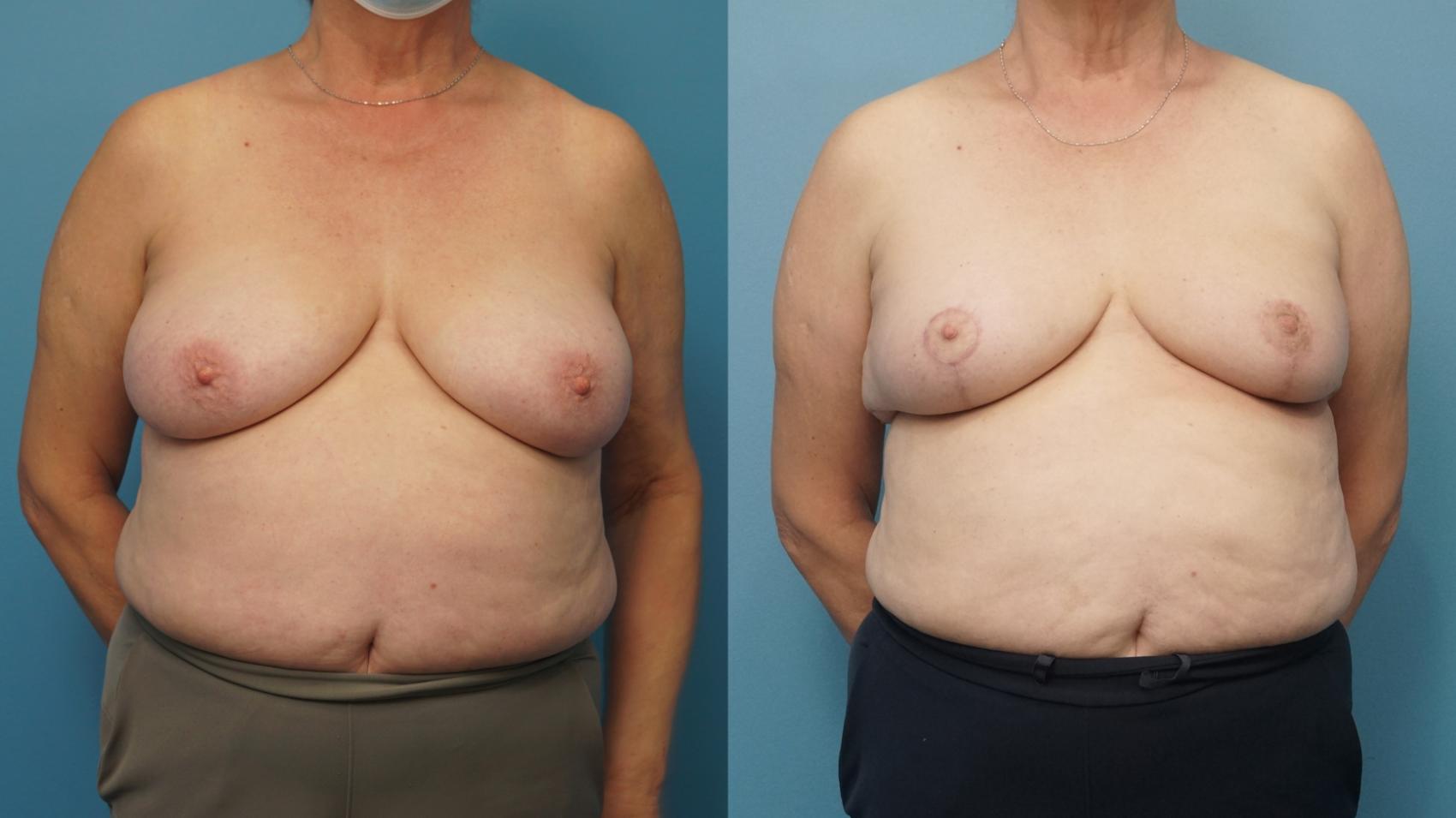 Before & After Oncoplastic Breast Reconstruction after Lumpectomy Case 437 Front View in North Shore, IL