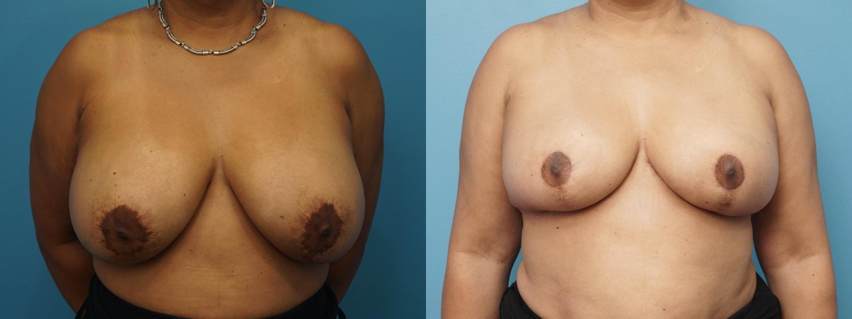 Before & After Oncoplastic Breast Reconstruction after Lumpectomy Case 444 Front View in North Shore, IL