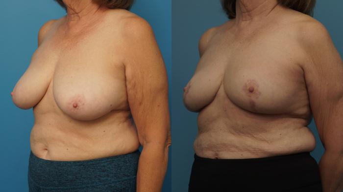 Before & After Oncoplastic Breast Reconstruction after Lumpectomy Case 477 Left Oblique View in North Shore, IL