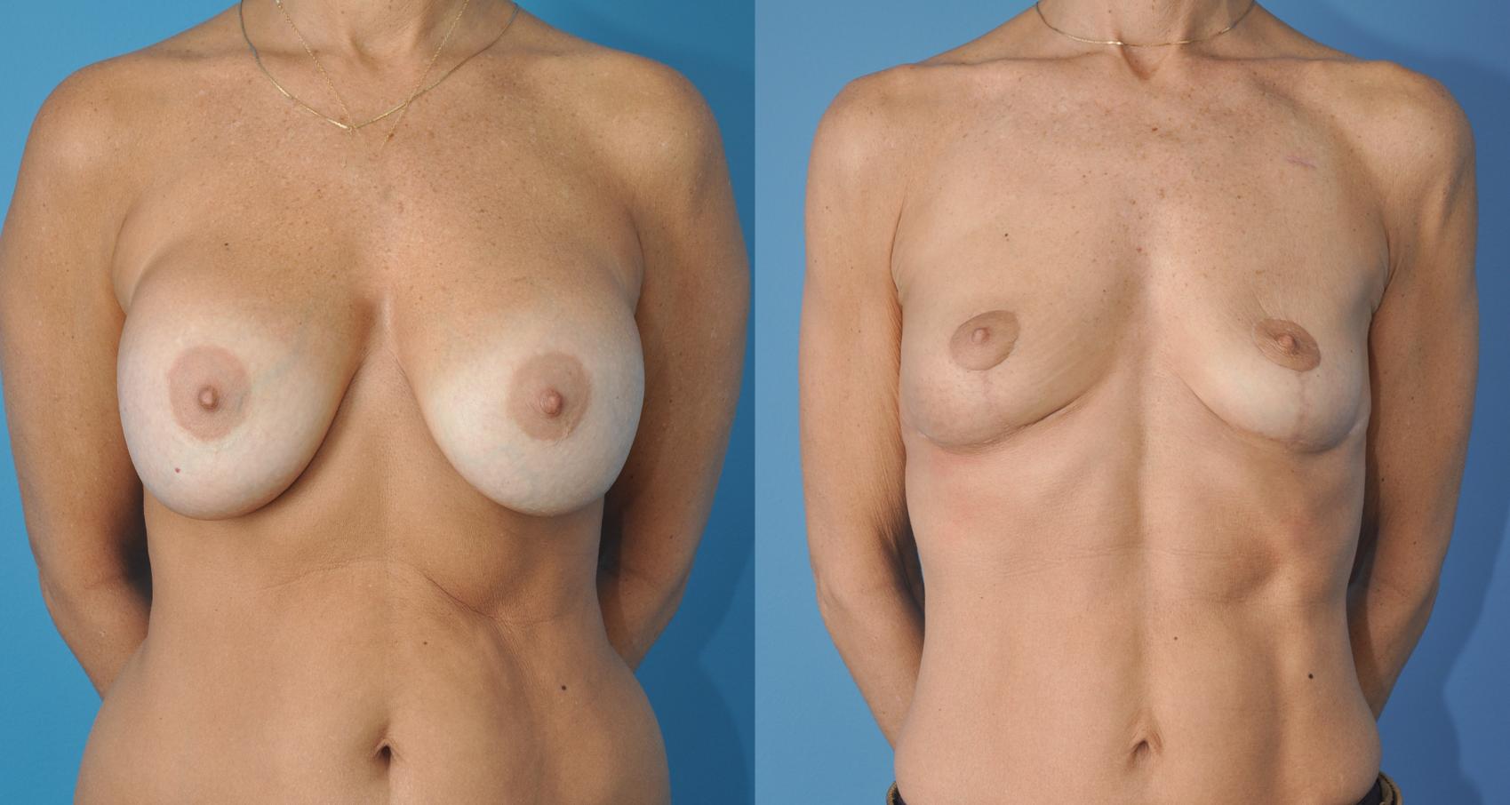 Before & After Oncoplastic Breast Reconstruction after Lumpectomy Case 80 View #1 View in North Shore, IL