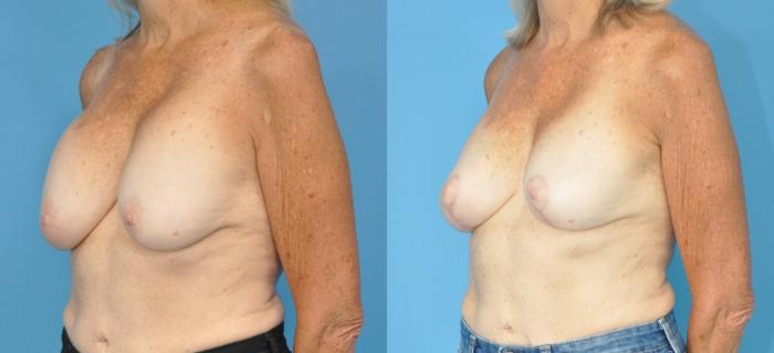 Before & After Revision Breast Surgery Case 181 View #1 View in Northbrook, IL