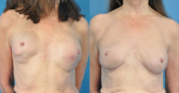 Before & After Breast Reconstruction with Implants Case 211 View #1 View in Northbrook, IL