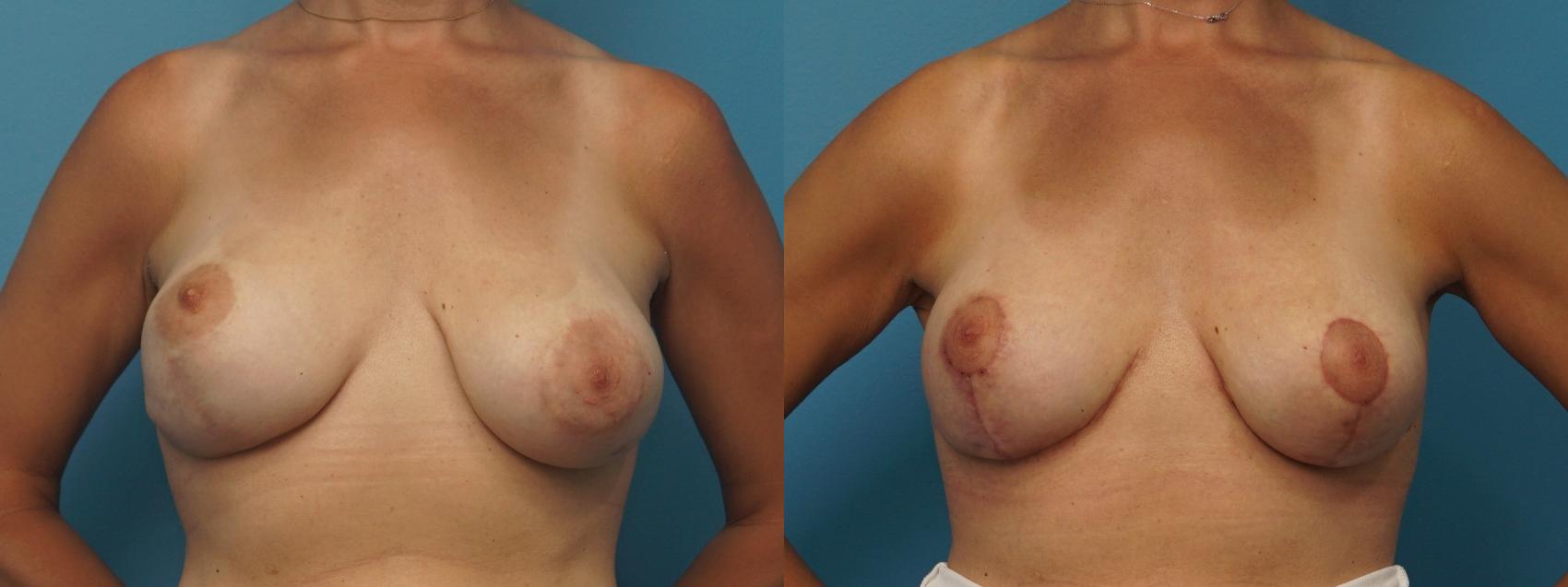 Before & After Breast Lift (Mastopexy) Case 361 Front View in North Shore, IL