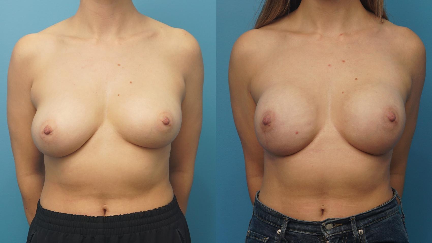 Before & After Revision Breast Surgery Case 367 Front View in Northbrook, IL