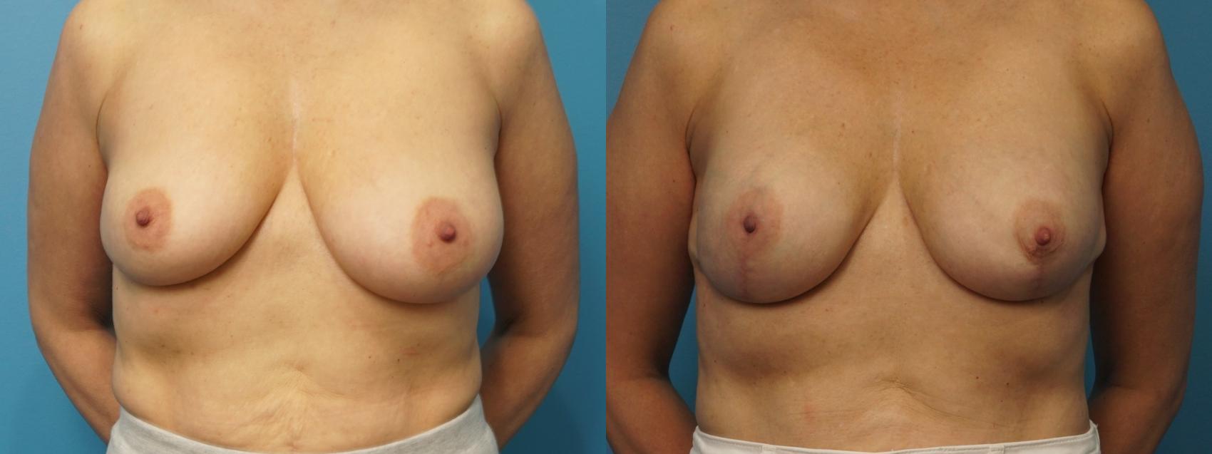 Before & After Revision Breast Surgery Case 372 Front View in North Shore, IL