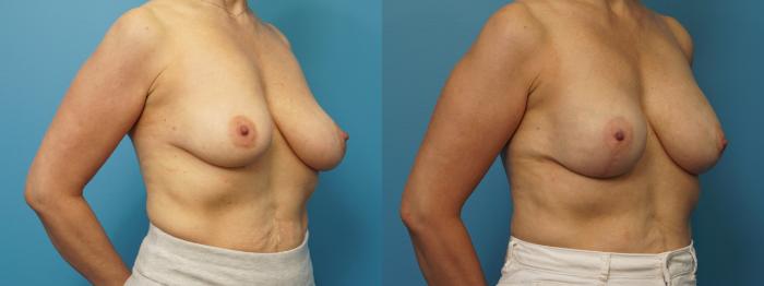 Before & After Revision Breast Surgery Case 372 Right Oblique View in North Shore, IL