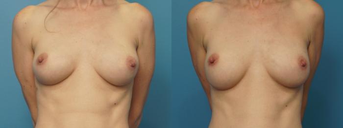 Before & After Revision Breast Surgery Case 383 Front View in Northbrook, IL