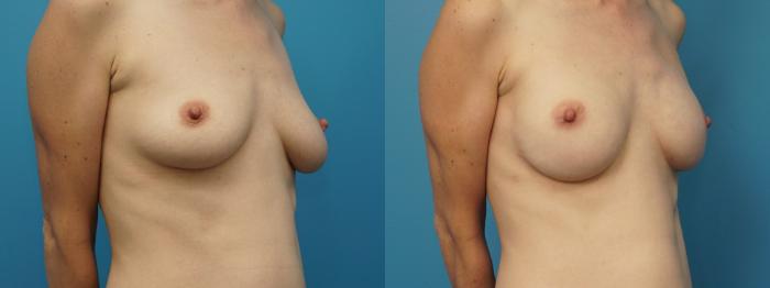 Before & After Revision Breast Surgery Case 383 Right Oblique View in North Shore, IL