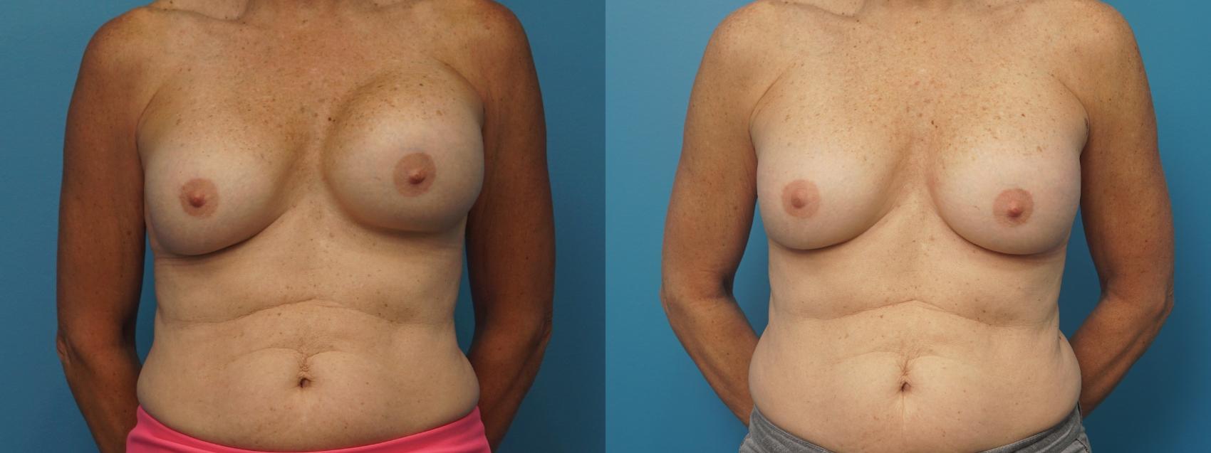 Before & After Revision Breast Surgery Case 385 Front View in Northbrook, IL