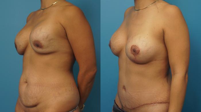 Before & After Revision Breast Surgery Case 401 Left Oblique View in North Shore, IL