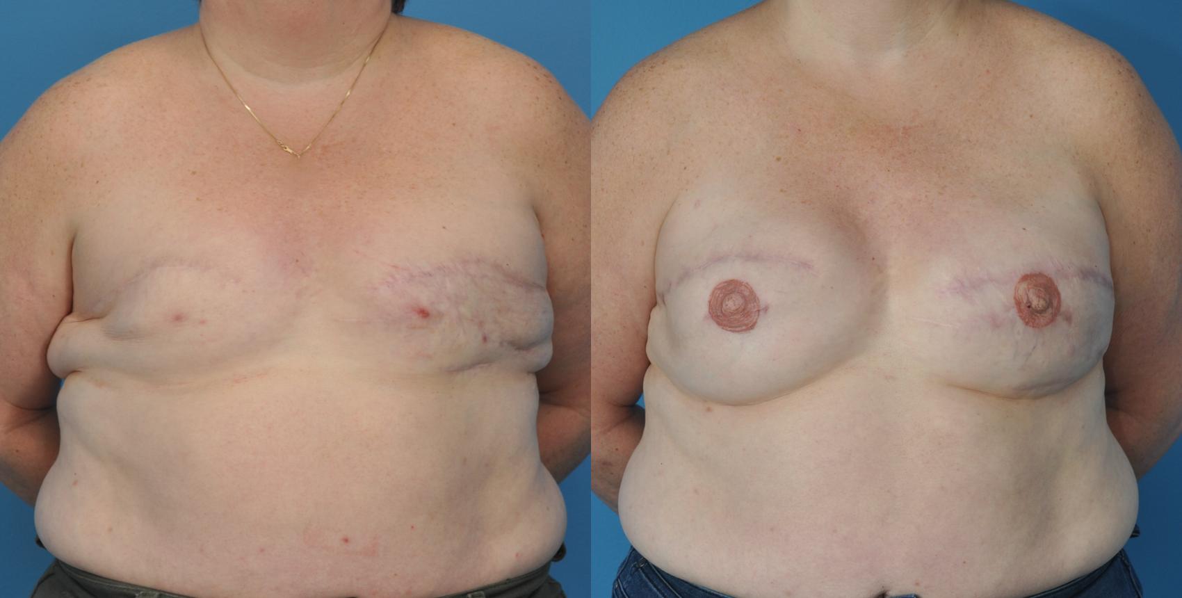 Before & After Revision Breast Surgery Case 50 View #1 View in Northbrook, IL