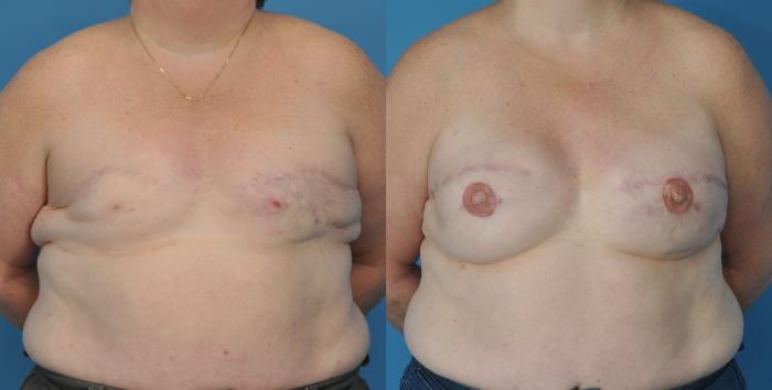 Before & After Revision Breast Surgery Case 50 View #1 View in North Shore, IL