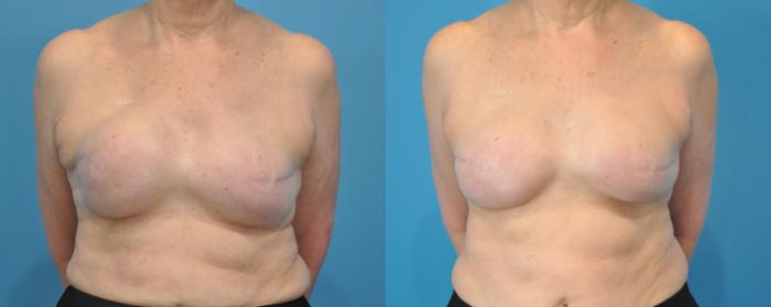 Before & After Revision Breast Surgery Case 79 View #1 View in Northbrook, IL