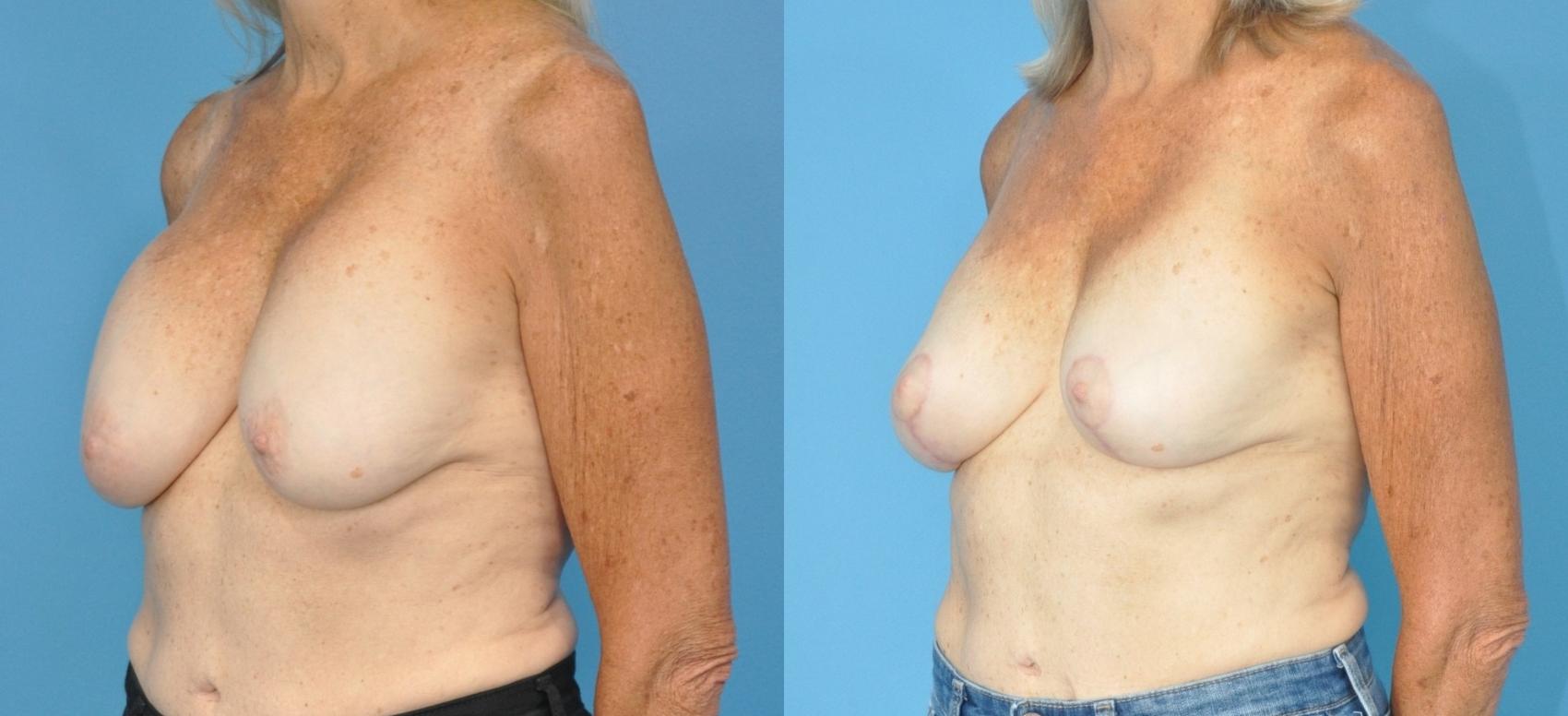 Before & After Revision of Aesthetic Breast Surgery Case 181 View #1 View in North Shore, IL