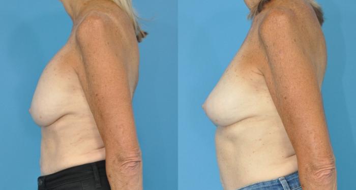 Before & After Breast Lift (Mastopexy) Case 181 View #2 View in North Shore, IL