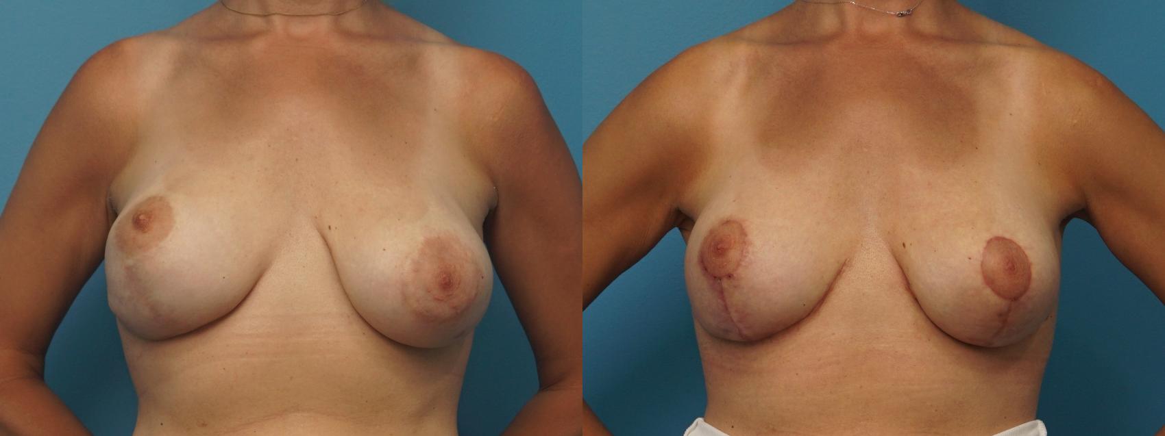 Before & After Revision of Aesthetic Breast Surgery Case 361 Front View in North Shore, IL