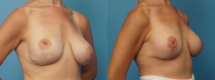 Before & After Revision of Aesthetic Breast Surgery Case 361 Oblique - Alt View in North Shore, IL