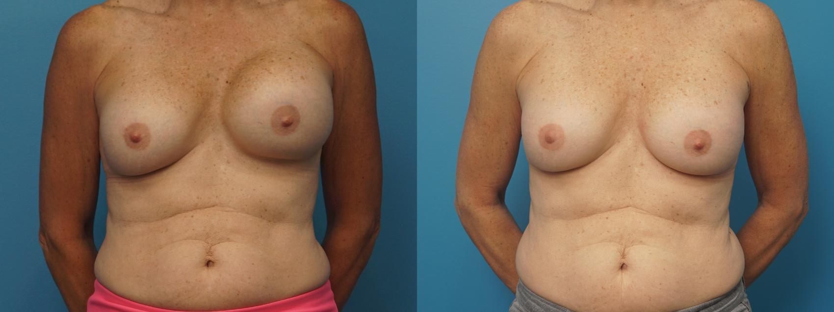 Before & After Revision of Aesthetic Breast Surgery Case 385 Front View in North Shore, IL