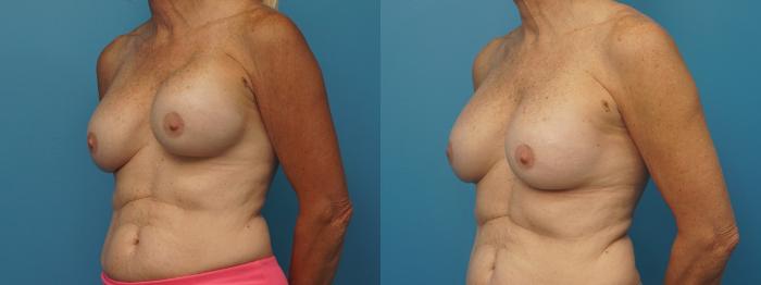 Before & After Revision of Aesthetic Breast Surgery Case 385 Left Oblique View in North Shore, IL