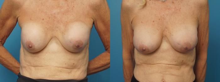 Before & After Revision of Aesthetic Breast Surgery Case 390 Front View in North Shore, IL