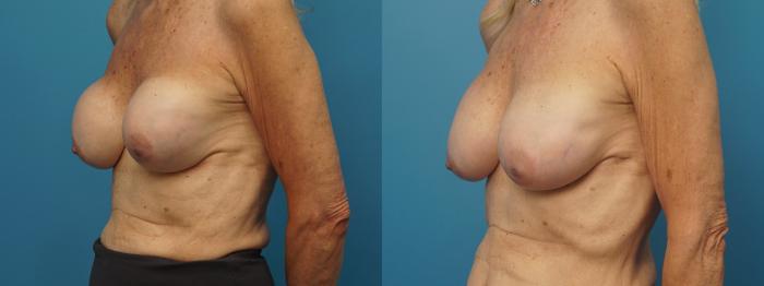 Before & After Revision of Aesthetic Breast Surgery Case 390 Left Oblique View in North Shore, IL