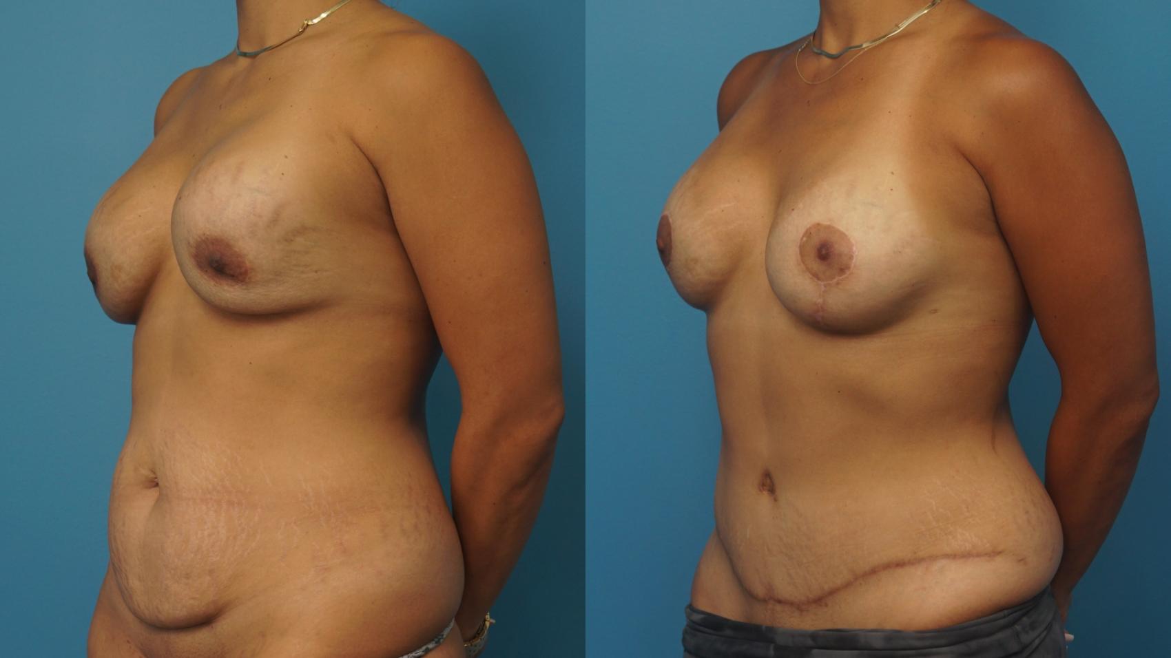 Before & After Revision of Aesthetic Breast Surgery Case 401 Left Oblique View in North Shore, IL