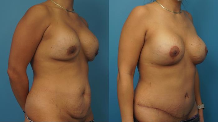 Before & After Revision of Aesthetic Breast Surgery Case 401 Right Oblique View in North Shore, IL