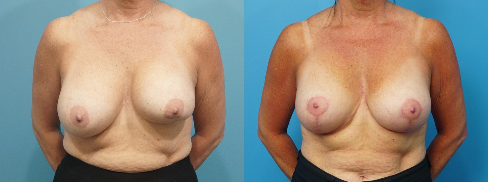 Before & After Revision of Aesthetic Breast Surgery Case 459 Front View in North Shore, IL