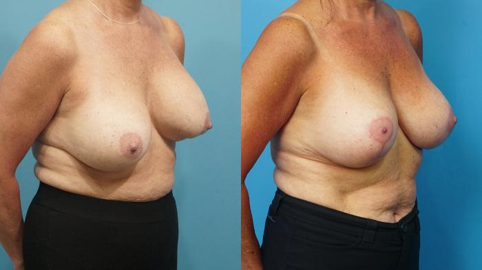 Before & After Breast Lift (Mastopexy) Case 459 Right Oblique View in North Shore, IL