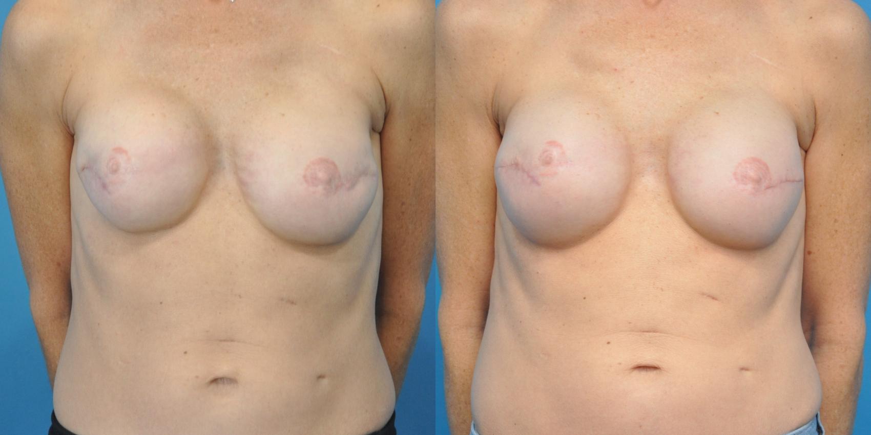 Before & After Revision of Breast Reconstruction Case 151 View #1 View in North Shore, IL