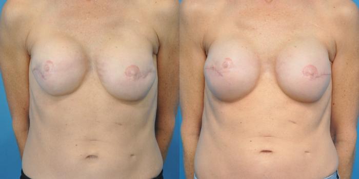 Before & After Revision of Breast Reconstruction Case 151 View #1 View in North Shore, IL