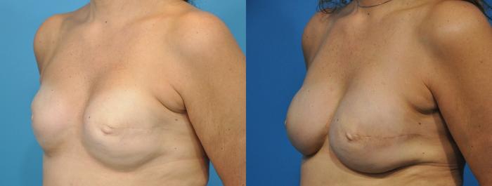 Before & After Revision of Breast Reconstruction Case 160 View #1 View in North Shore, IL