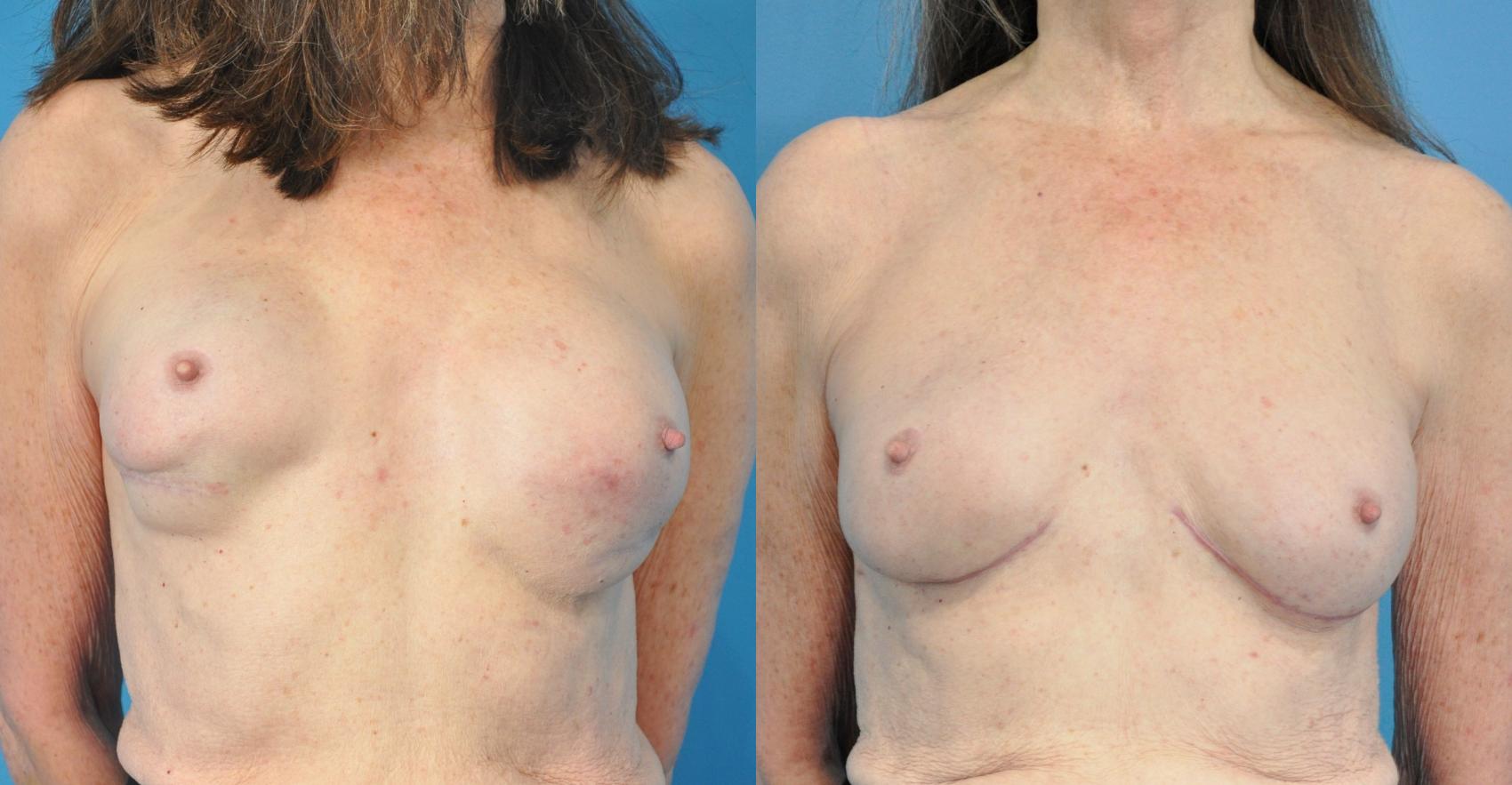 Before & After Revision of Breast Reconstruction Case 211 View #1 View in North Shore, IL