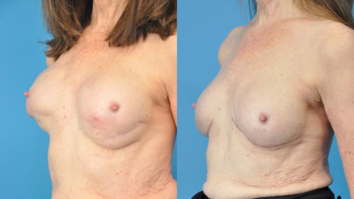 Before & After Revision of Aesthetic Breast Surgery Case 211 View #2 View in North Shore, IL