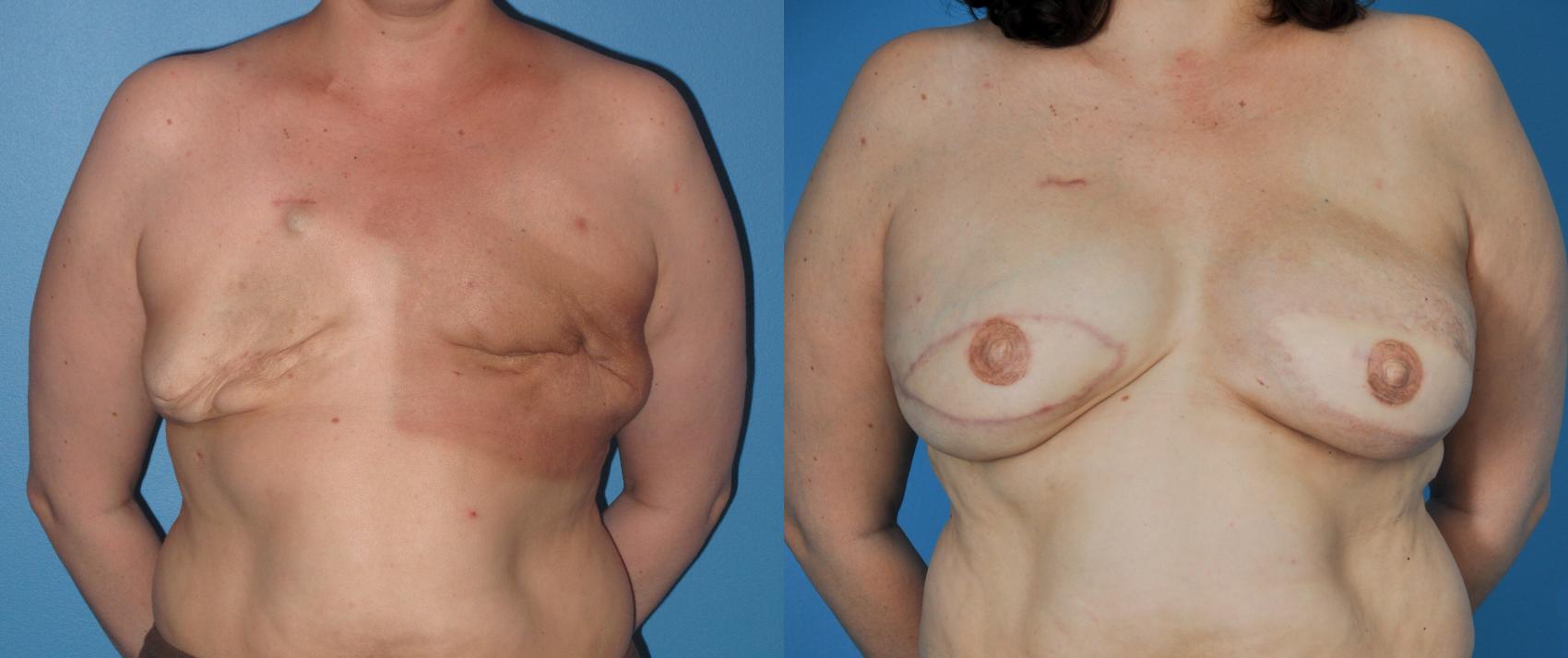 Before & After Breast Reconstruction with Latissimus Flaps Case 42 View #1 View in North Shore, IL