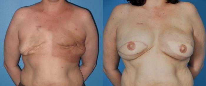 Before & After Revision of Breast Reconstruction Case 42 View #1 View in North Shore, IL