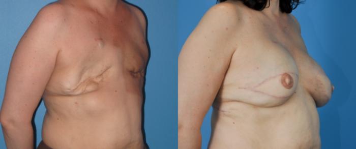 Before & After Revision of Breast Reconstruction Case 42 View #3 View in North Shore, IL