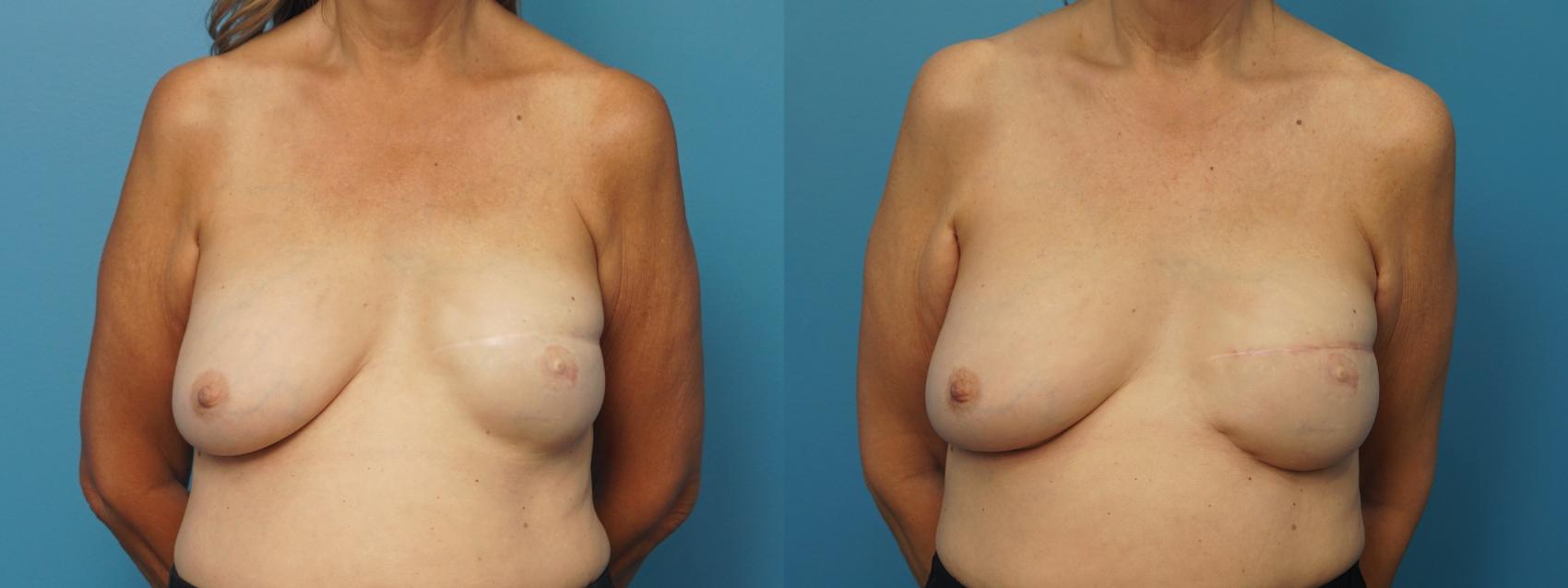 Before & After Revision of Breast Reconstruction Case 475 Front View in North Shore, IL