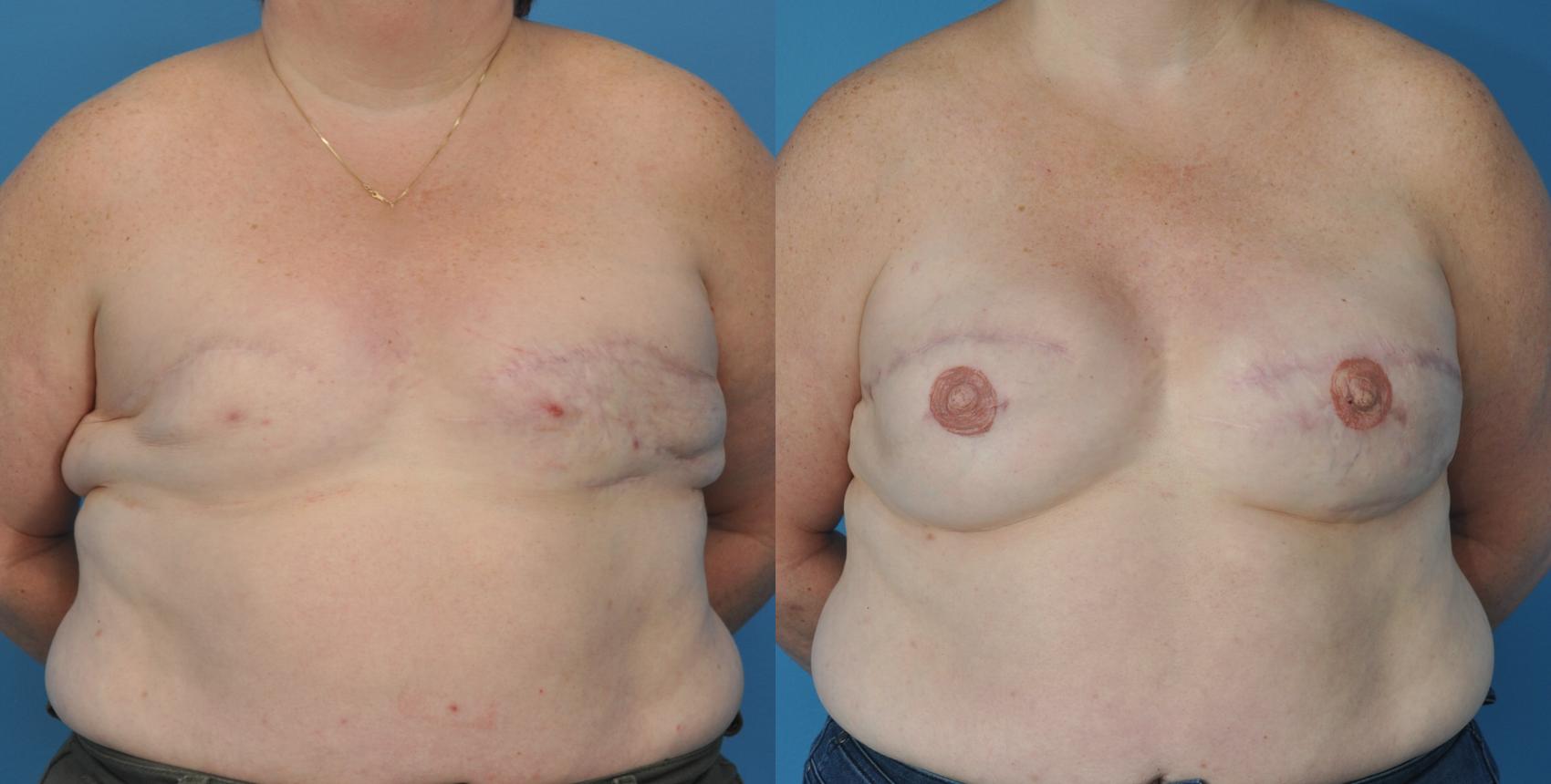 Before & After Revision of Breast Reconstruction Case 50 View #1 View in North Shore, IL