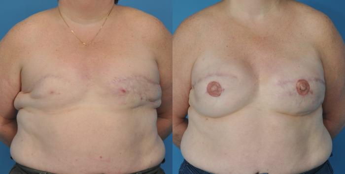 Before & After Revision of Breast Reconstruction Case 50 View #1 View in North Shore, IL