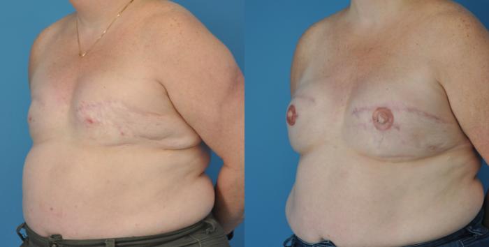 Before & After Revision of Breast Reconstruction Case 50 View #2 View in North Shore, IL