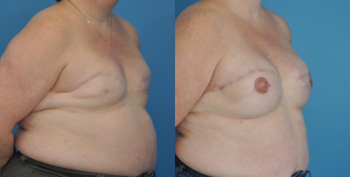 Before & After Revision of Breast Reconstruction Case 50 View #3 View in North Shore, IL