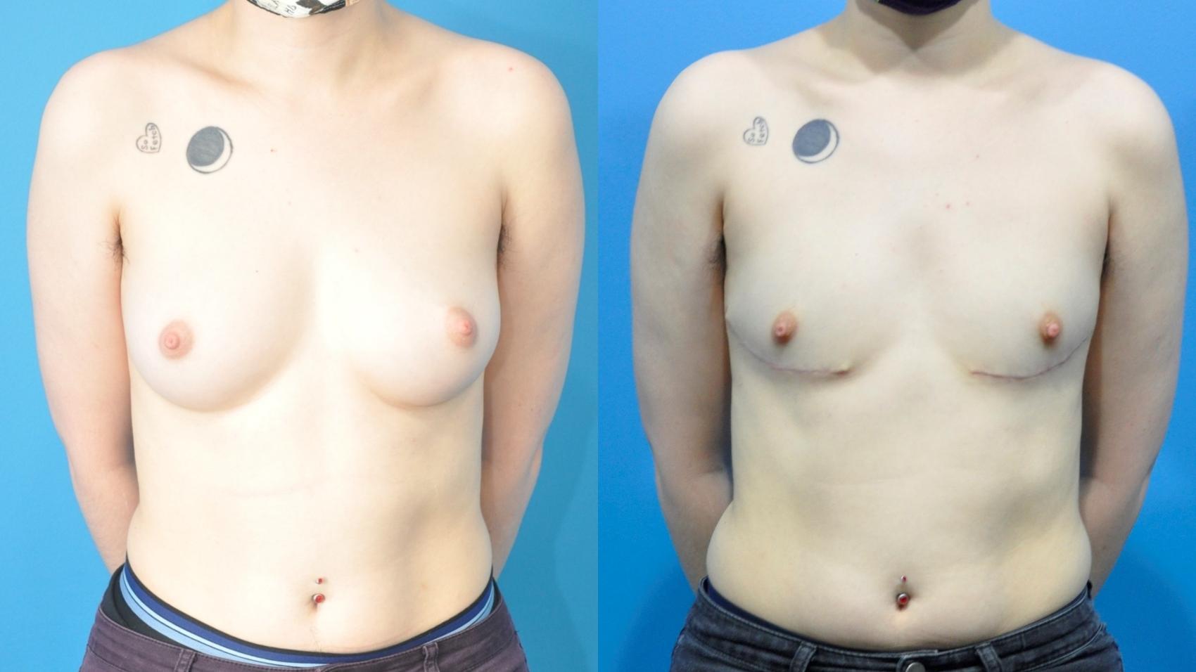 Before & After Gender Affirmation (Top Surgery) Case 354 Front View in North Shore, IL