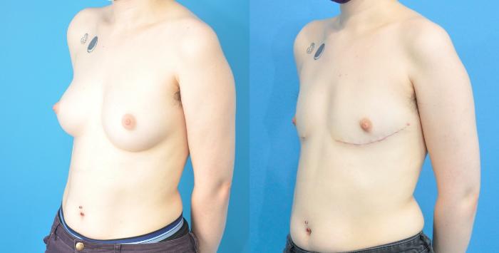 Before & After Gender Affirmation (Top Surgery) Case 354 Left Oblique View in North Shore, IL