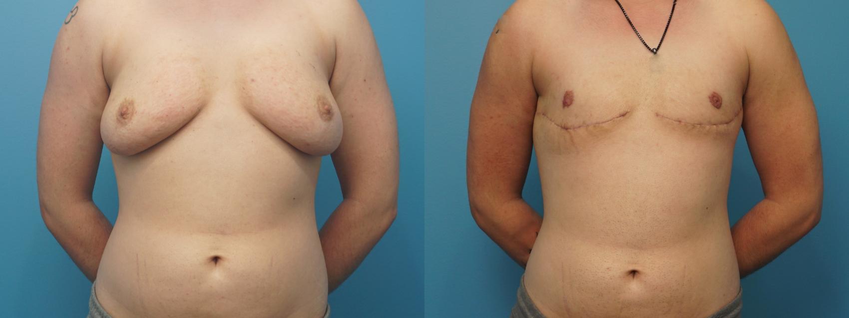 Before & After Gender Affirmation (Top Surgery) Case 374 Front View in North Shore, IL