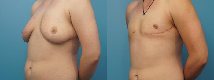 Before & After Gender Affirmation (Top Surgery) Case 374 Left Oblique View in North Shore, IL