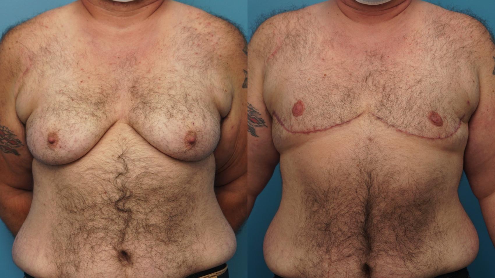 Before & After Gender Affirmation (Top Surgery) Case 402 Front View in North Shore, IL